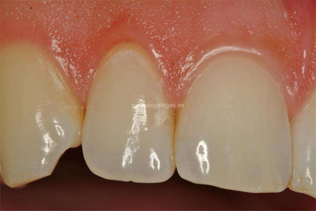 Corrección del Ronquido - Clínica Dental Víctor Alonso de la Peña