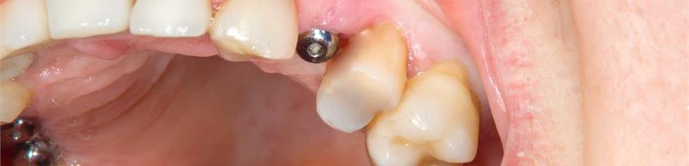 Implantes dentales en Galicia